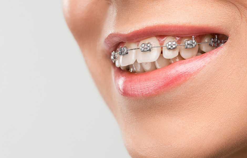 Di sí a la ortodoncia en adultos